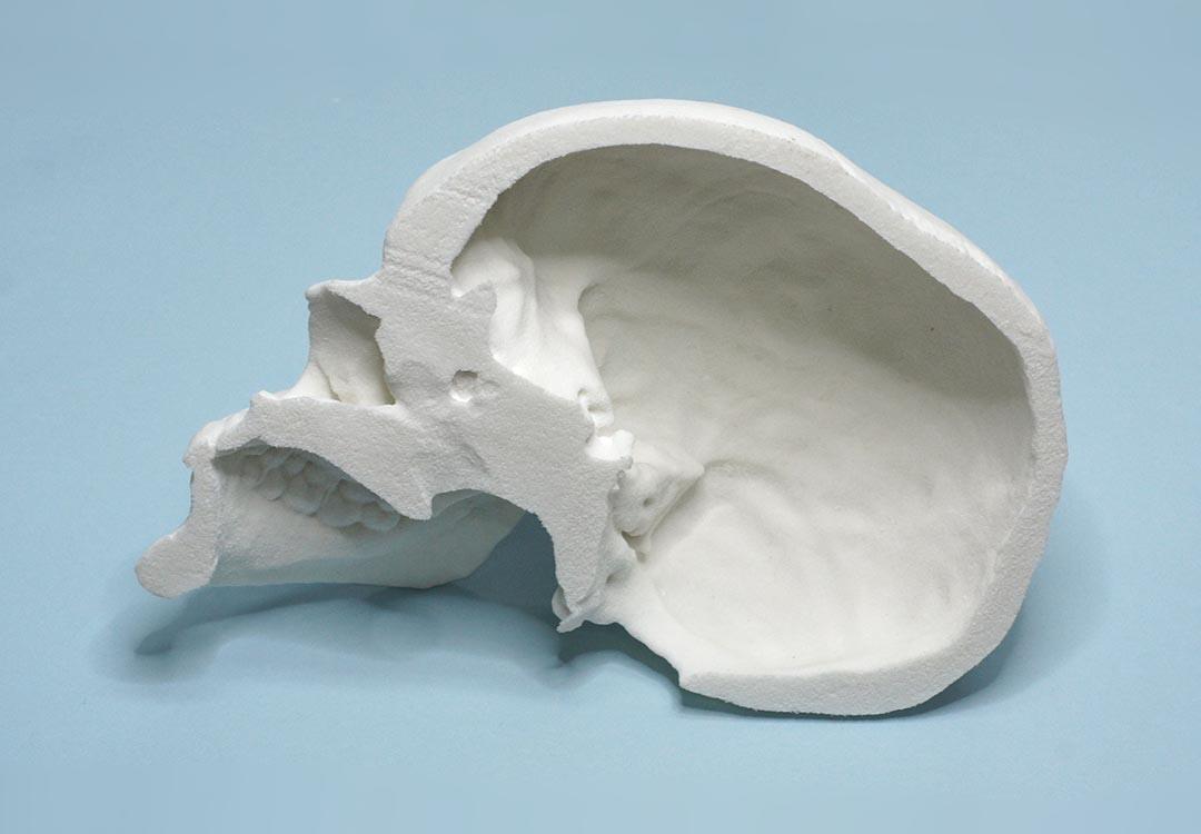 Przykładowe implanty Chirurgia 3D