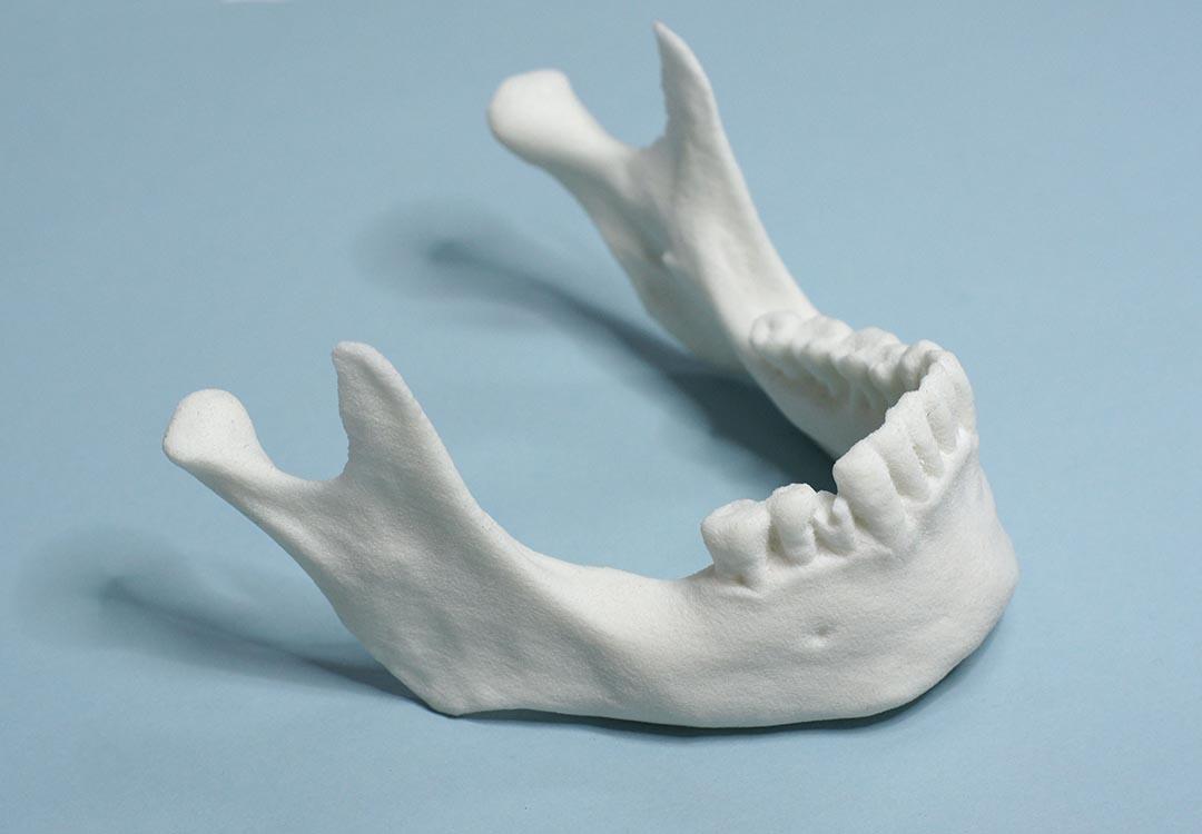 Przykładowe implanty Chirurgia 3D