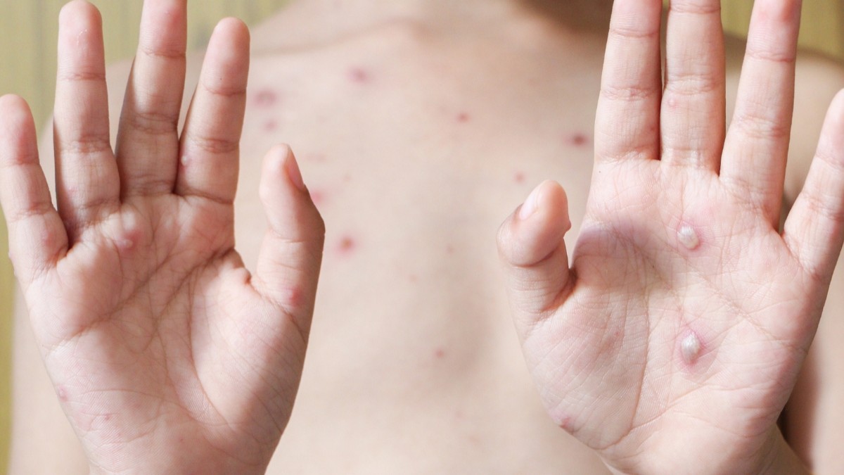 Małpia ospa dotarła do Norwegii. Osoba z objawami przebywała w Oslo