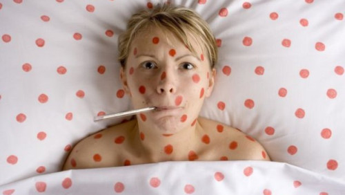 Epidemia różyczki w Polsce - norweski Instytut zdrowia publicznego zaleca szczepienia