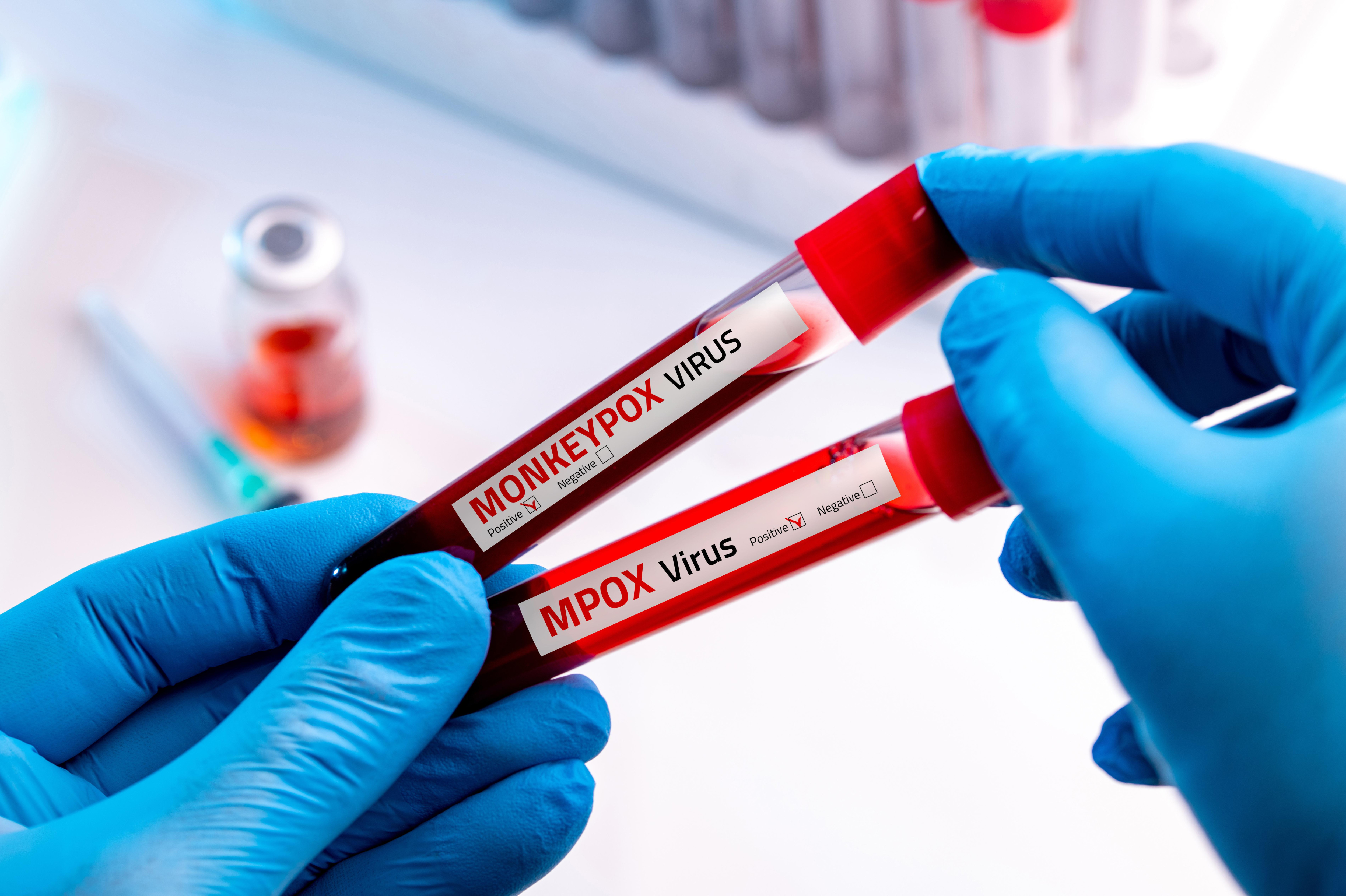 Od dwóch lat nowy wariant wywołującego mpox wirusa rozprzestrzenia się także po  Europie i Ameryce Północnej.