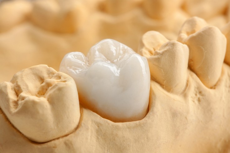 korona ceramiczna